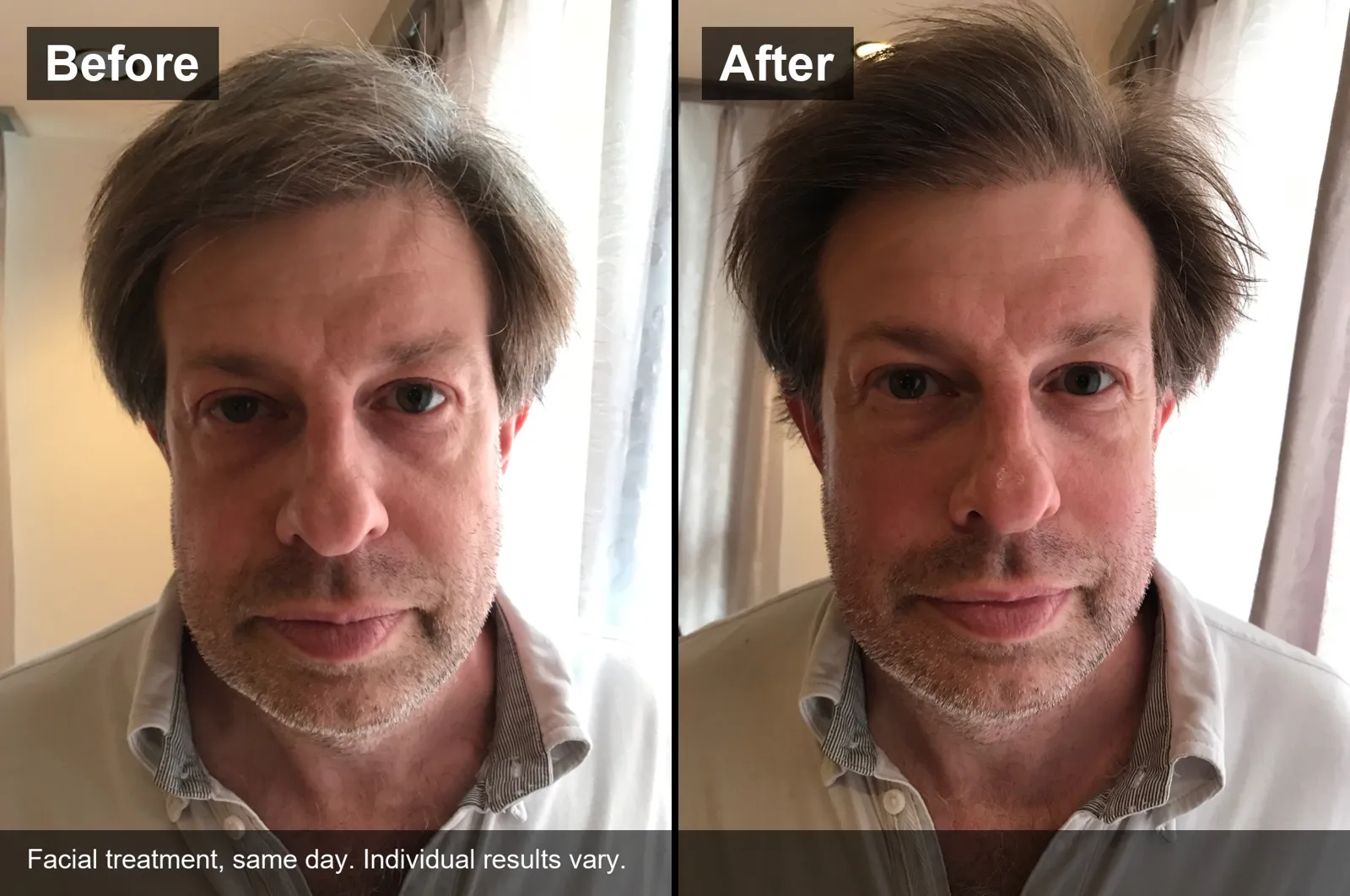 Before and after a facial treatment on the same day, international guest