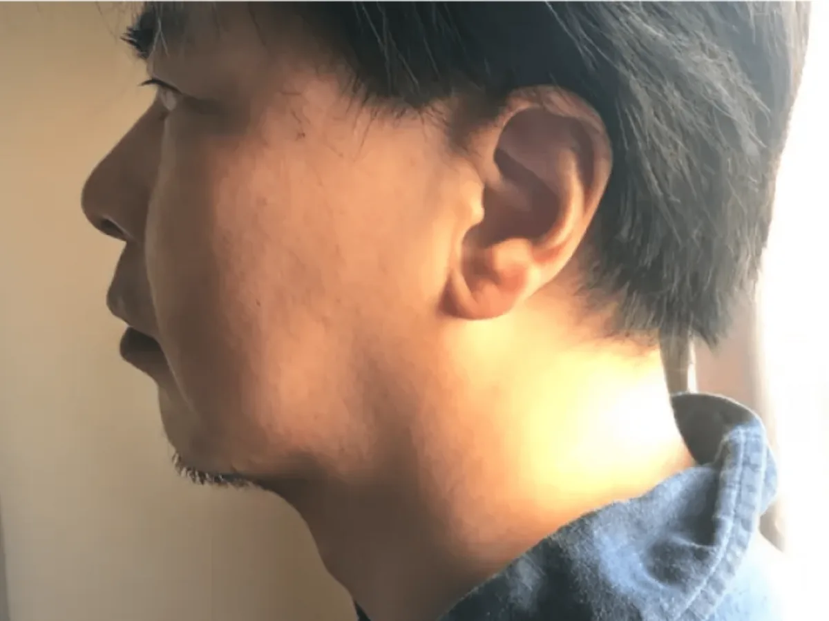 むくみが取れシャープになったAfter