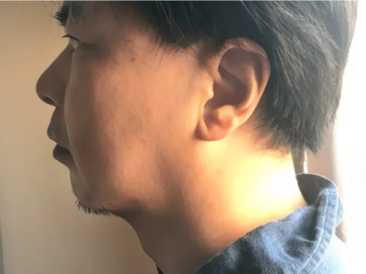 フェイシャル施術後。フェイスラインが引き締まった男性の横顔