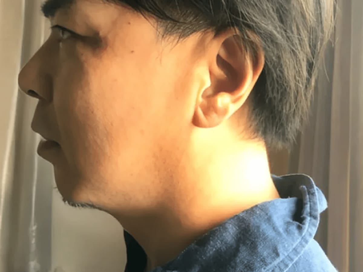 フェイシャル施術前。顔のむくみで輪郭がぼやけた状態の男性の横顔