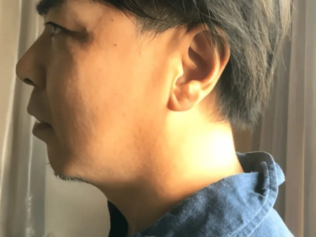 フェイシャル施術前。顔のむくみで輪郭がぼやけた状態の男性の横顔